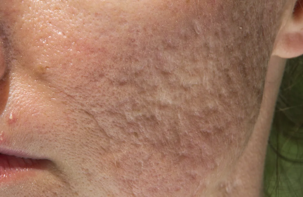 หลุมสิวแบบไหนรักษาด้วย TCA ได้บ้าง