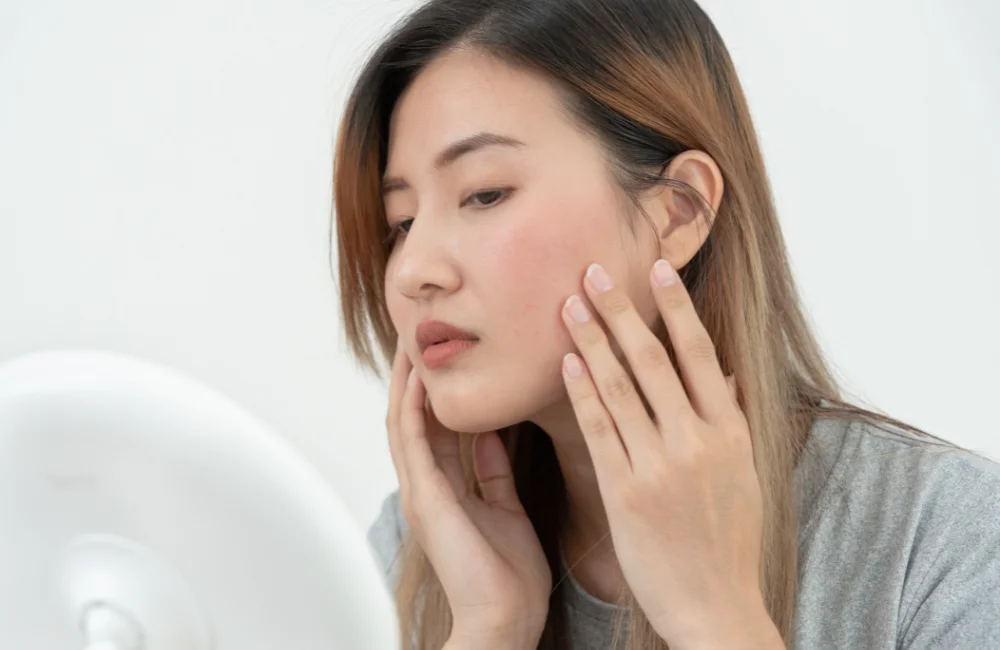 Subcision หลุมสิว คืออะไร