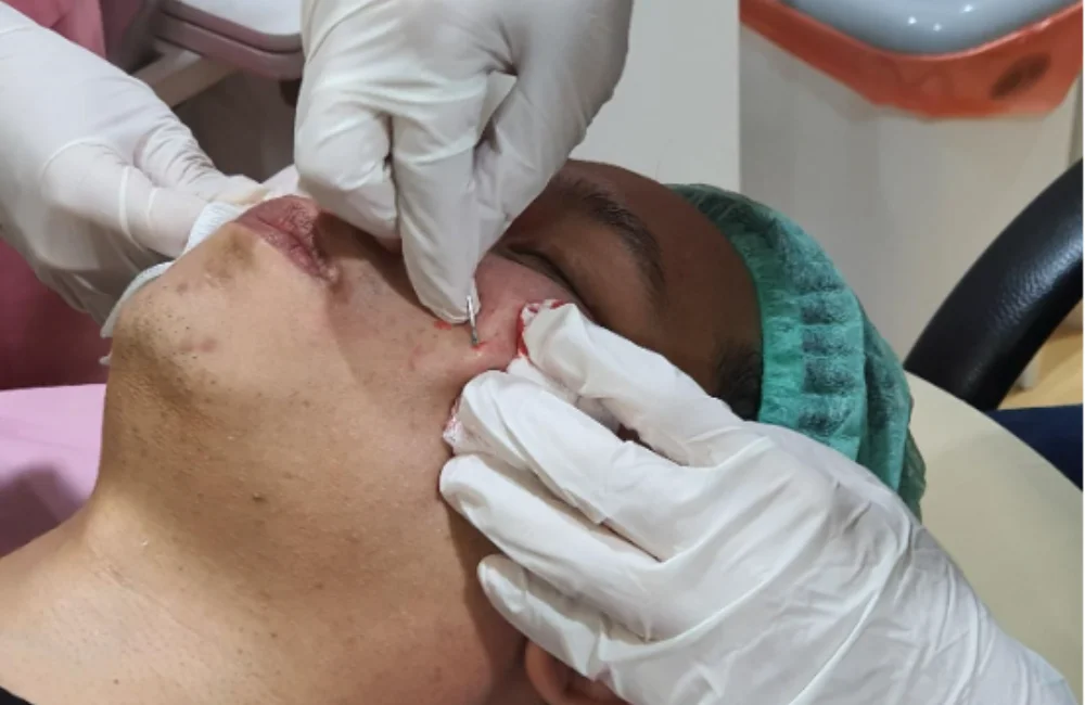 รักษาหลุมสิว Subcision ที่ Dr. Bank Clinic