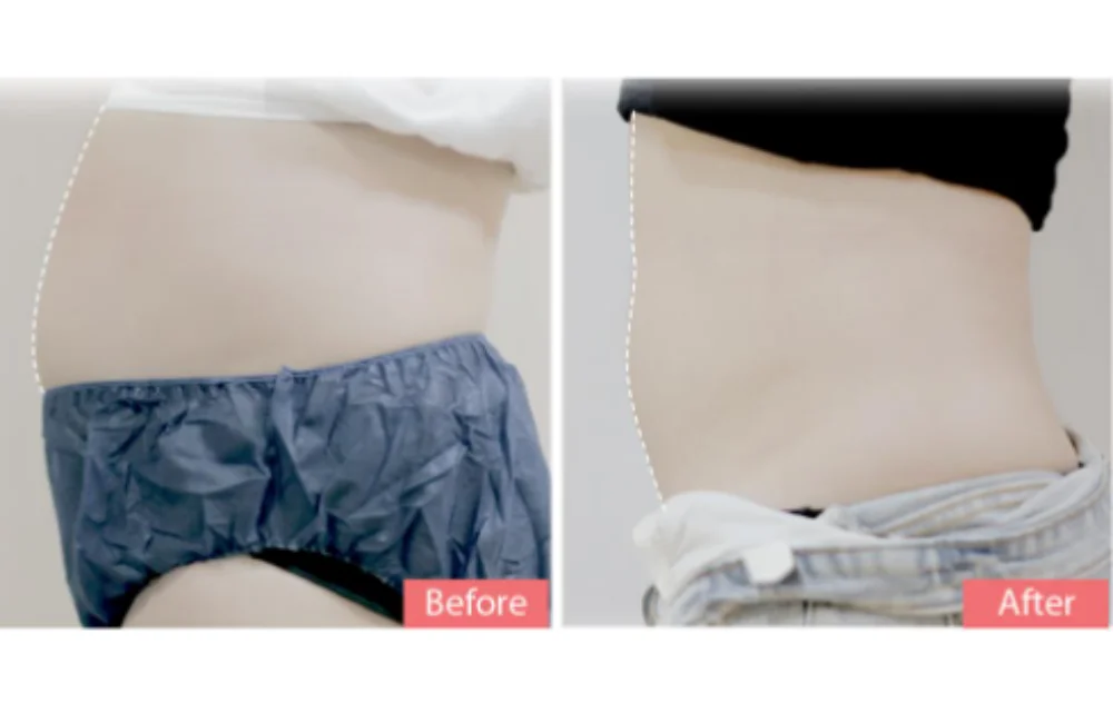 คสรีวิวที่ 1 การทำ Cooltech สลายไขมันด้วยความเย็นที่ Dr. Bank Clinic