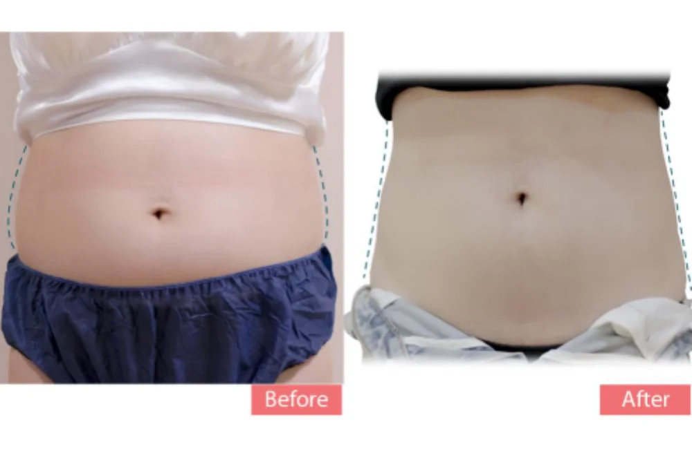 เคสรีวิวที่ 2 การทำ Cooltech สลายไขมันด้วยความเย็นที่ Dr. Bank Clinic