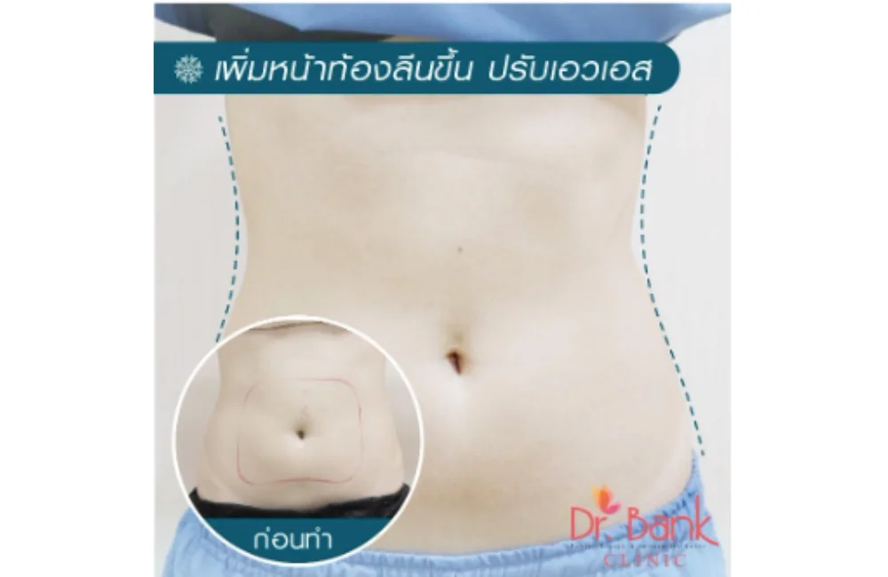 รีวิวสลายไขมันความเย็นบริเวณหน้าท้อง