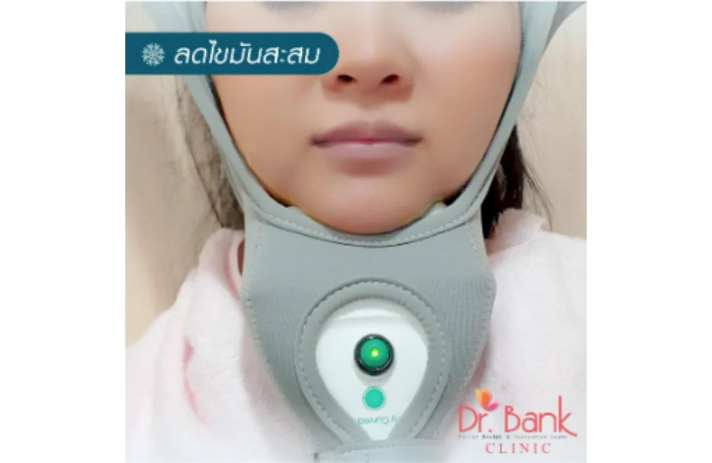 รีวิวสลายไขมันความเย็นบริเวณเหนียง