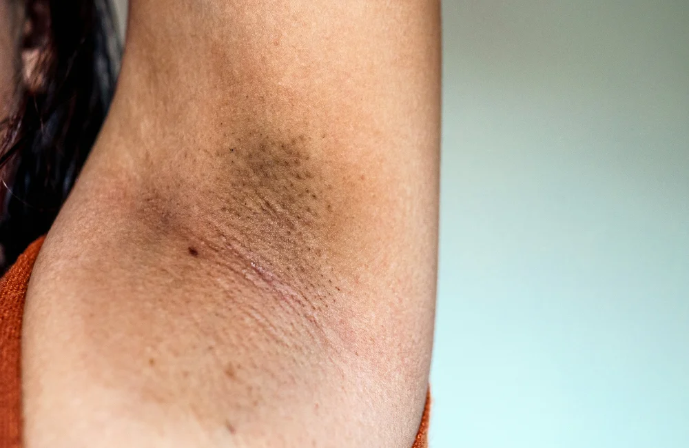 รักแร้เป็นรอยพับและเป็นหนังไก่