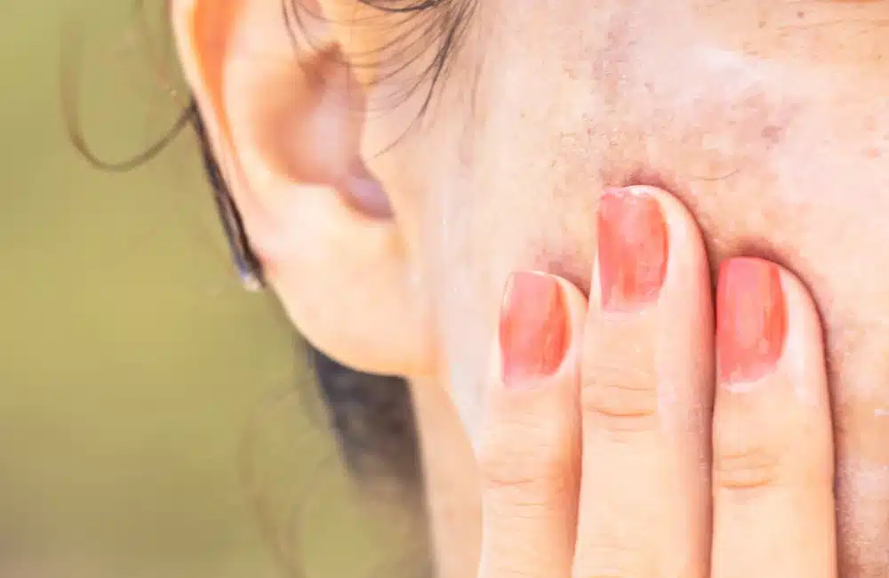 ฝ้าแดดบริเวณโหนกแก้ม