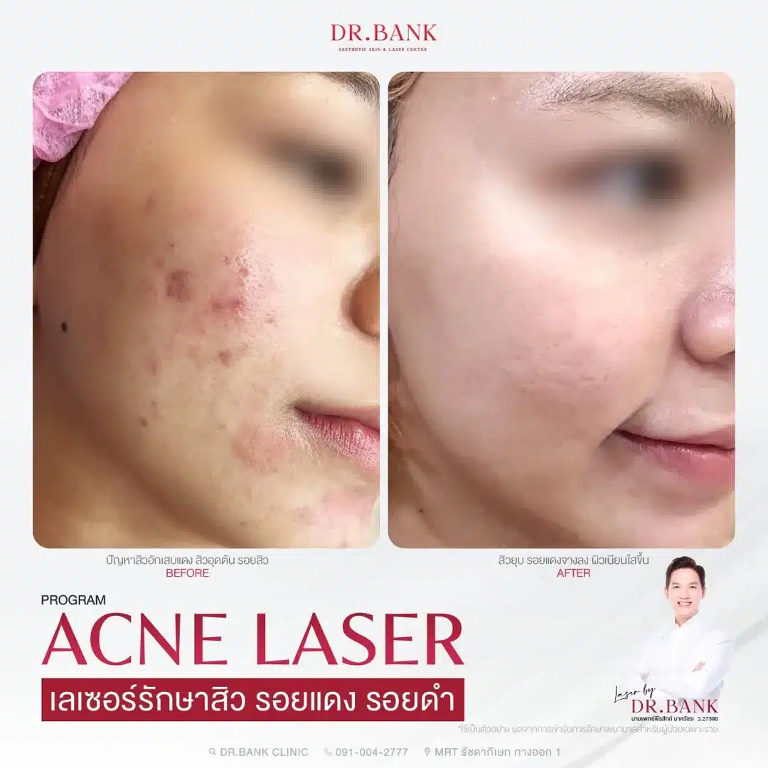 โปรแกรมรักษาสิว