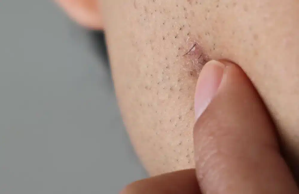 ขนคุด เกิดจากอะไร