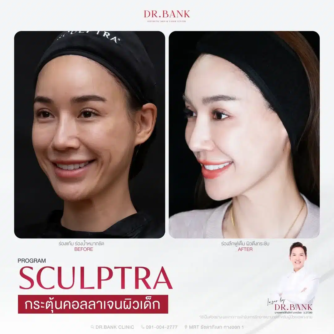ยกกระชับหน้าด้วย Sculptar