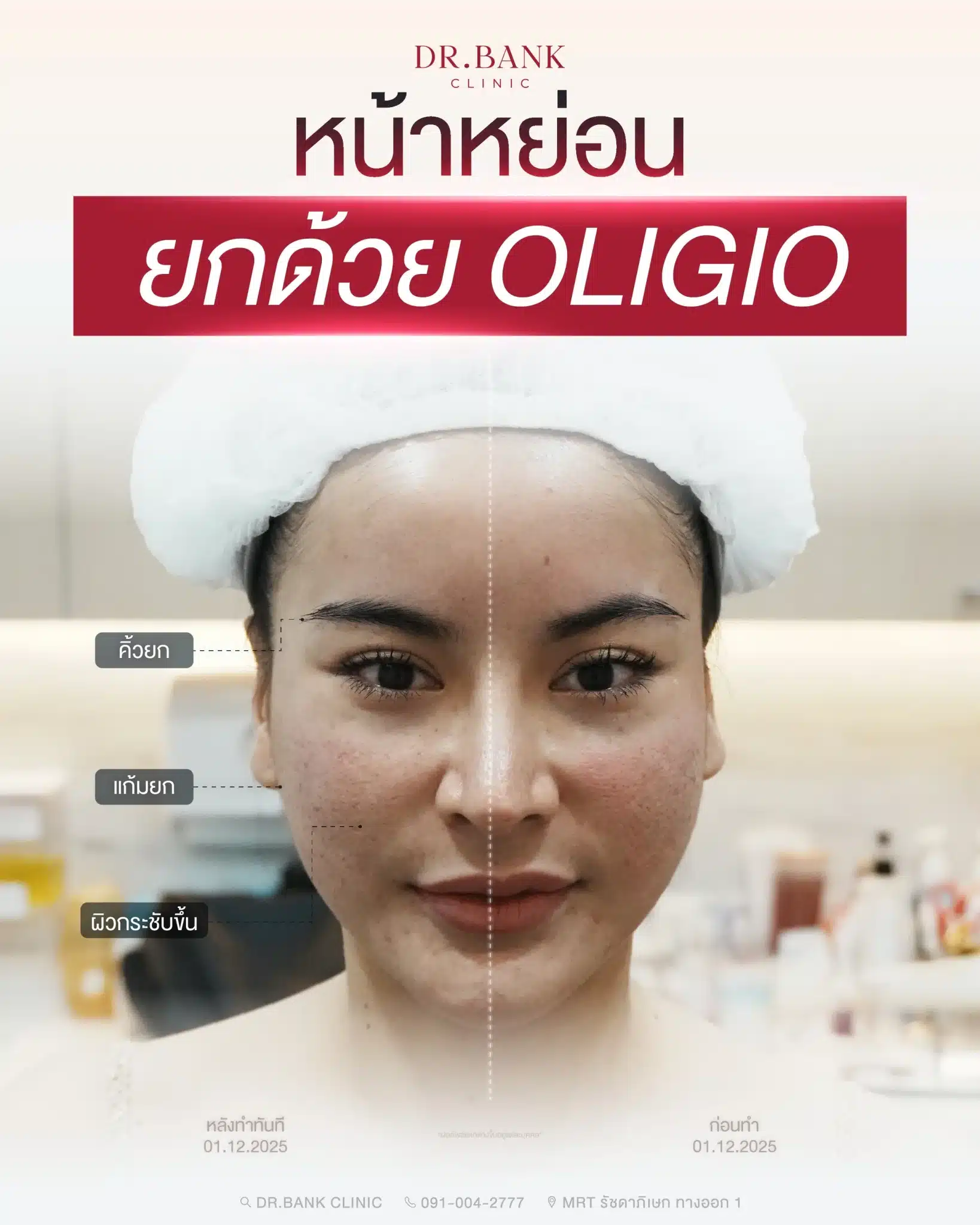 ยกกระชับหน้าด้วย Oligio