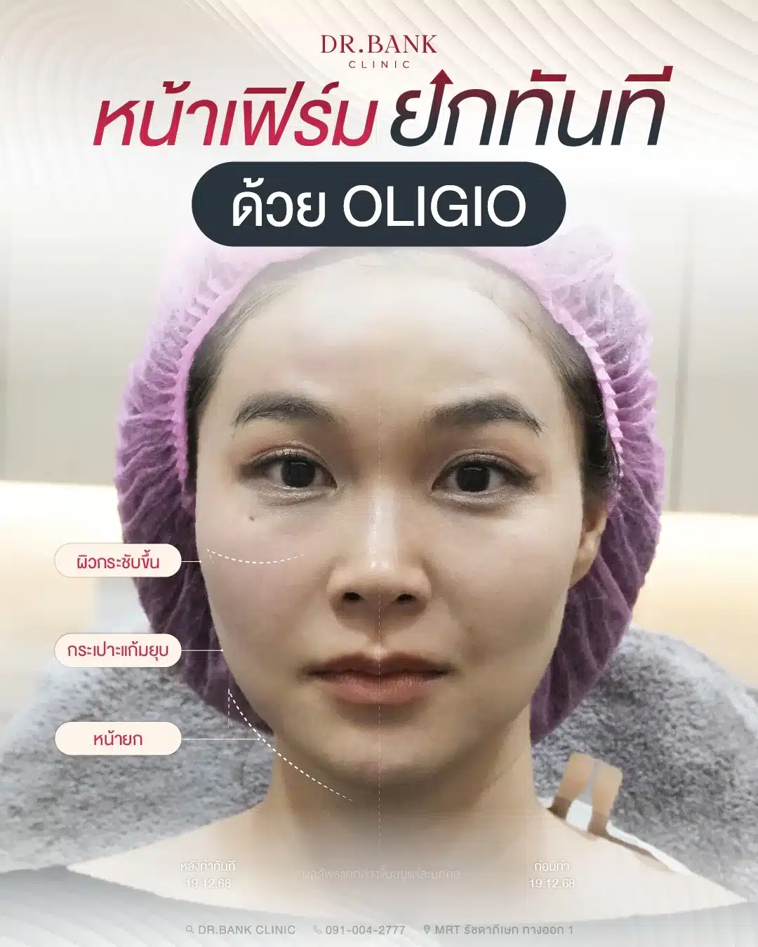 ยกกระชับหน้าด้วย Oligio