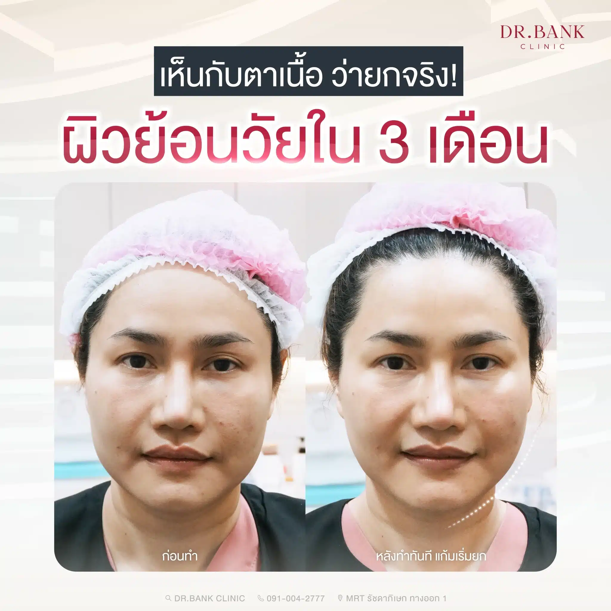 หลังทำ Oligio