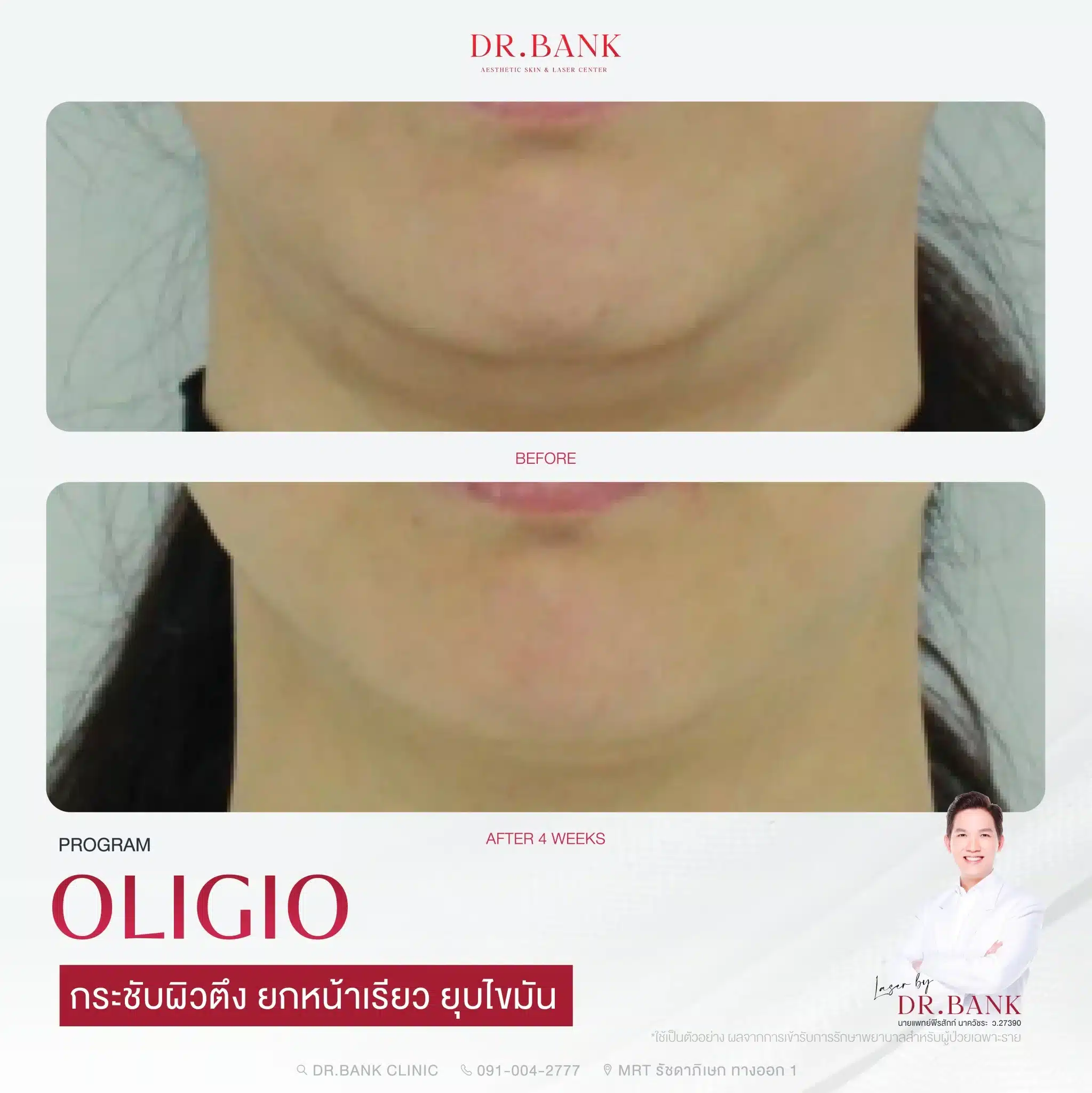 ยกหน้า ลดไขมัน