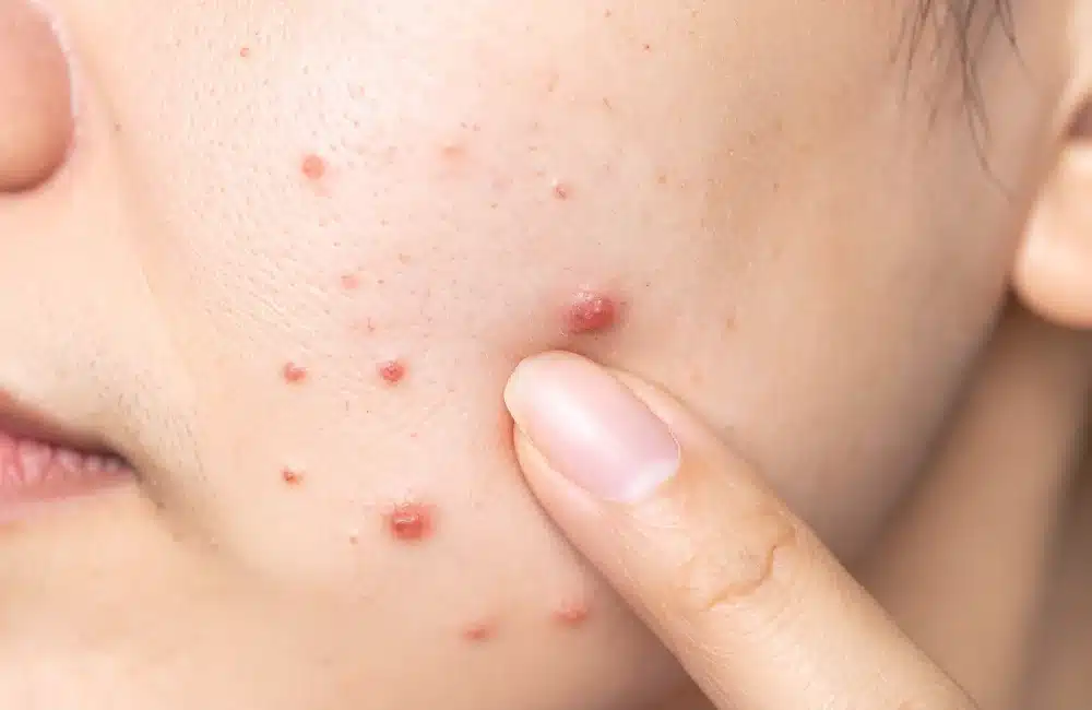 สิวอักเสบขึ้นไม่หยุด