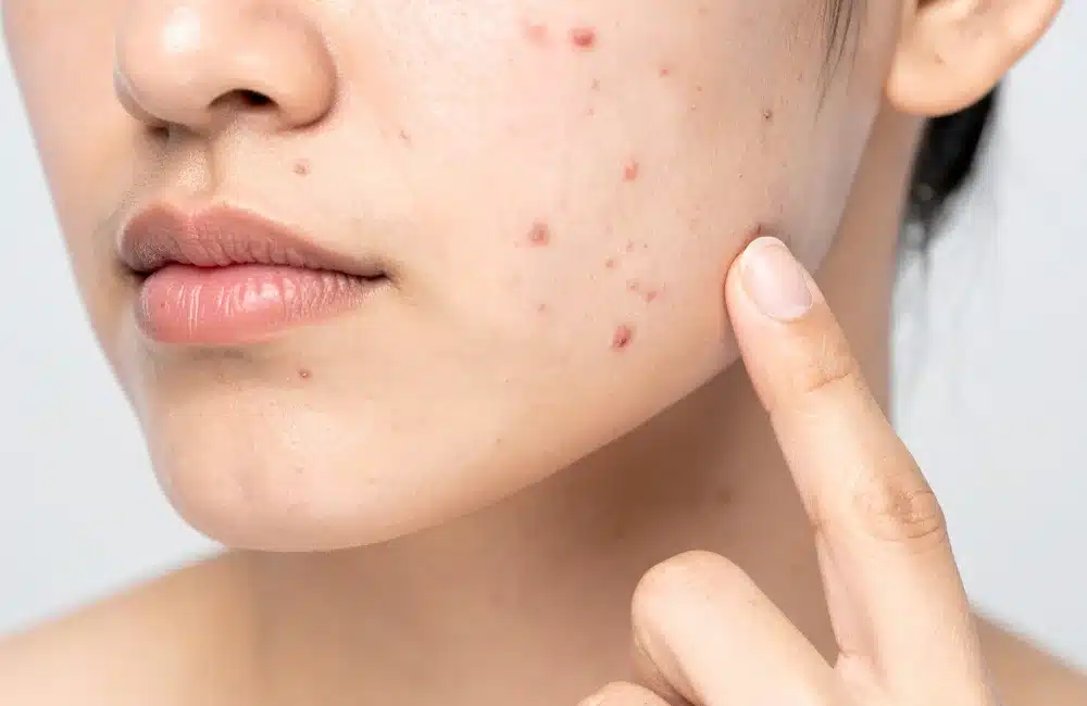 สิวอักเสบขึ้นไม่หยุด