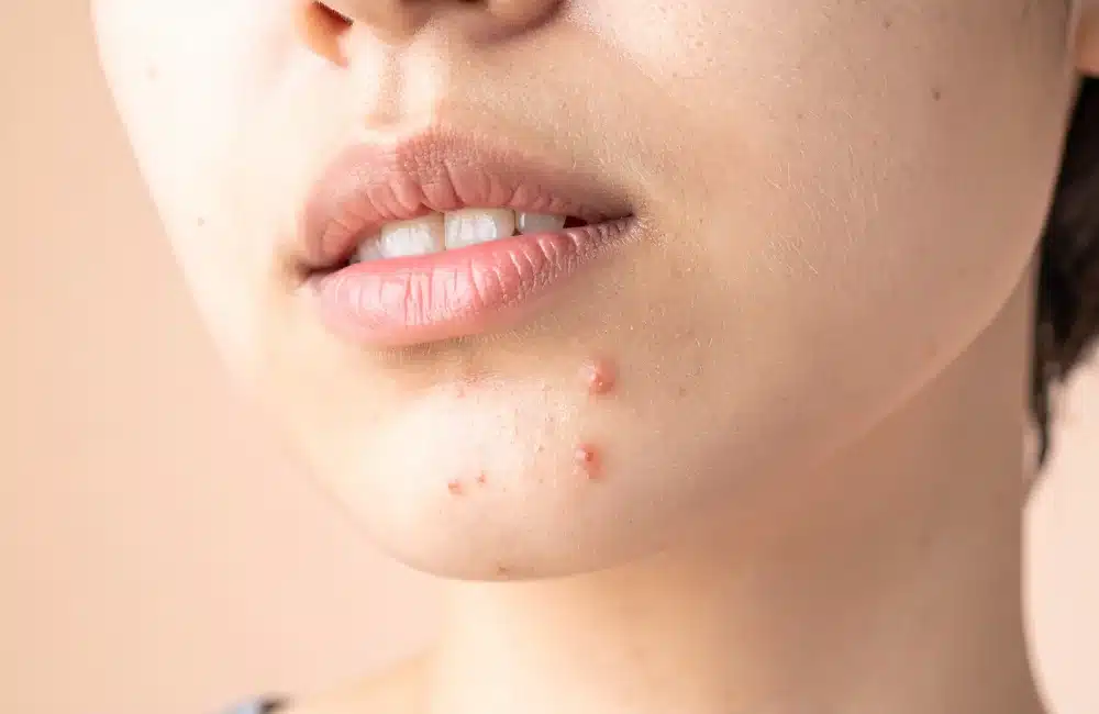 สิวอักเสบขึ้นไม่หยุด