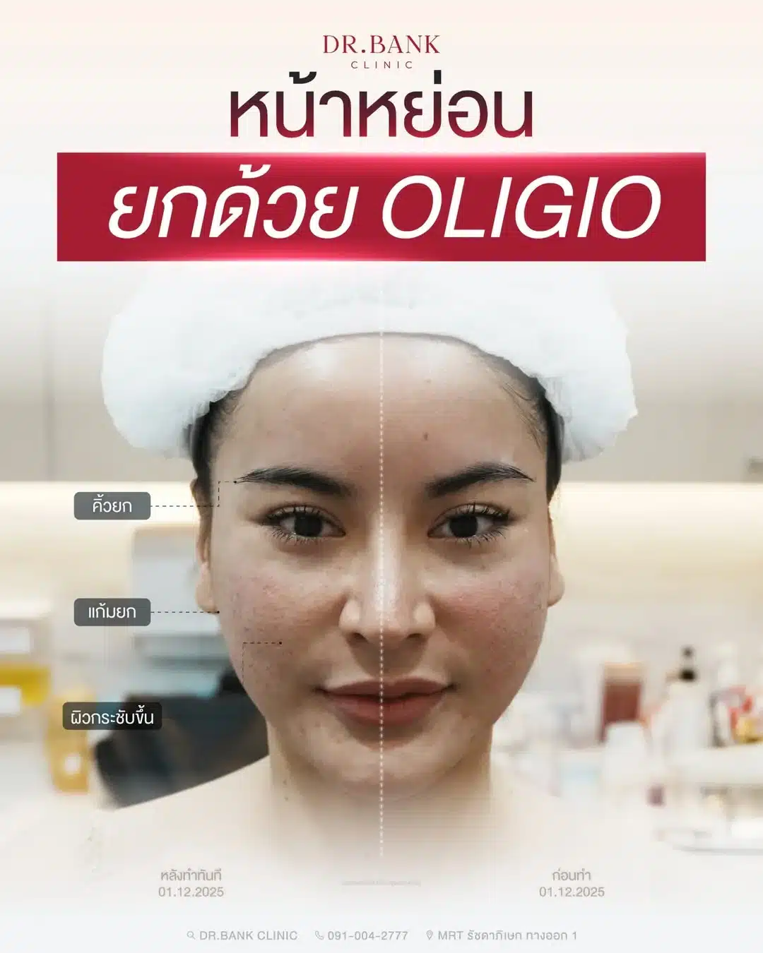 แก้ปัญหาหน้าหย่อนคล้อย Oligio