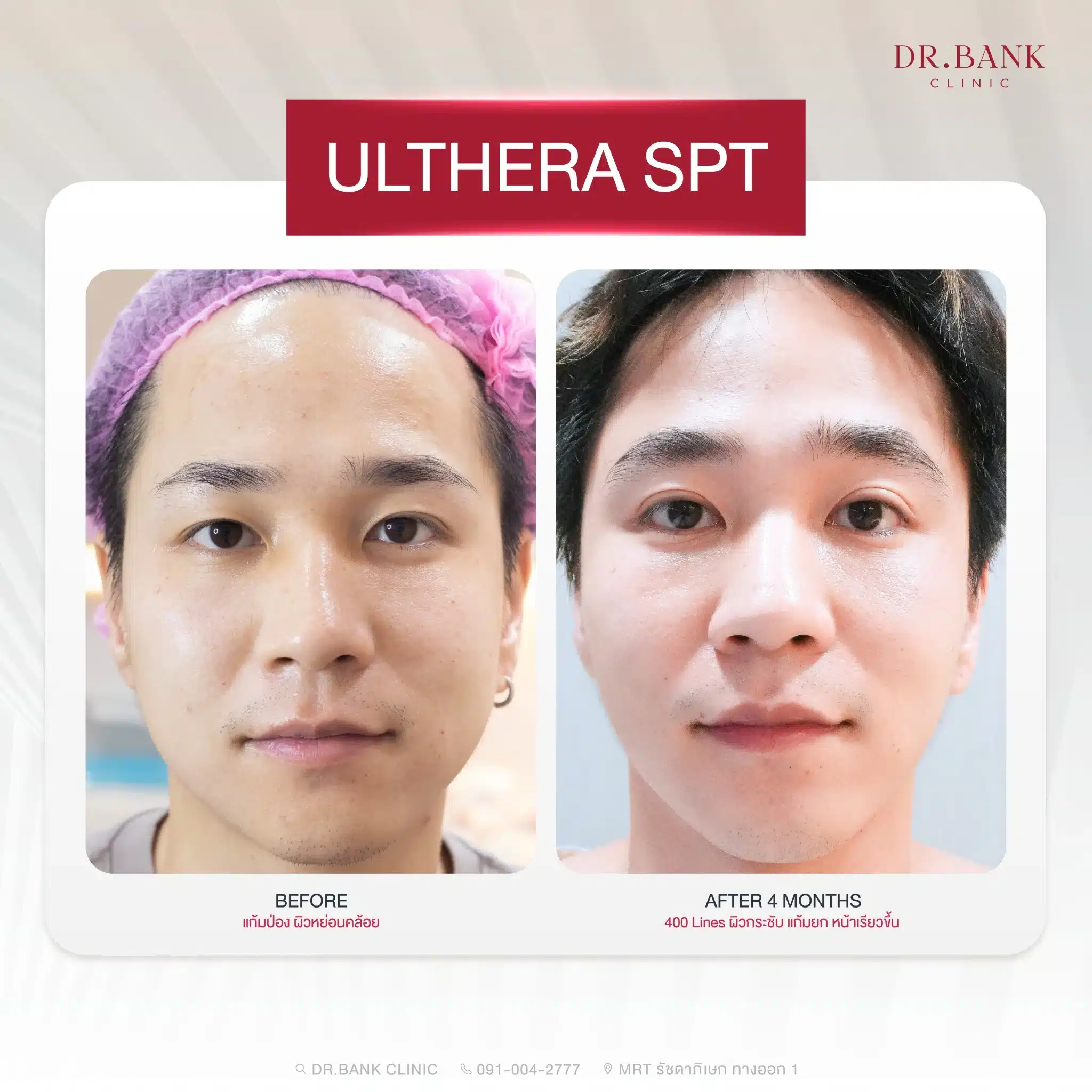 ยกกระชับใบหน้าผู้ชาย