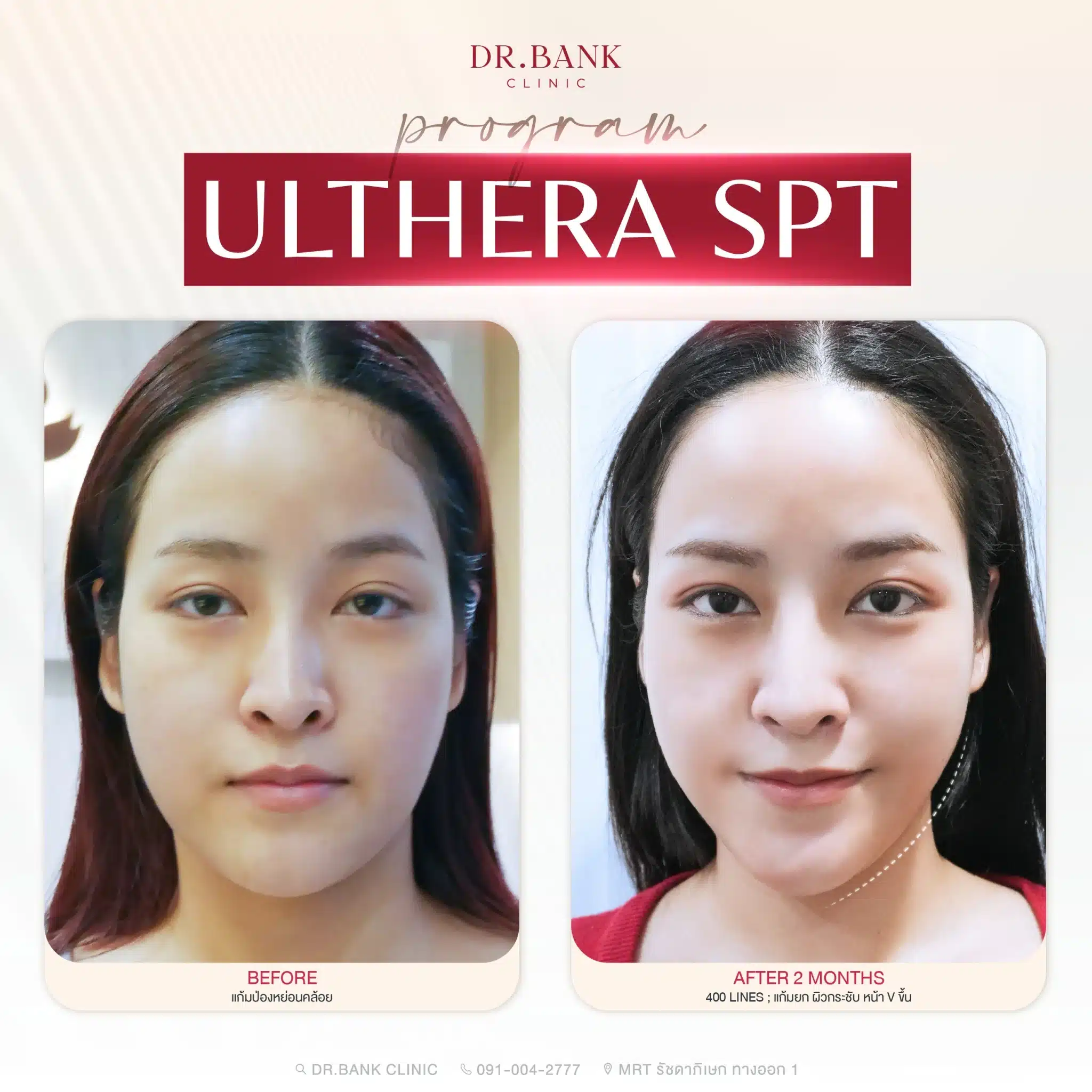 Ulthera ยกกระชับหน้า