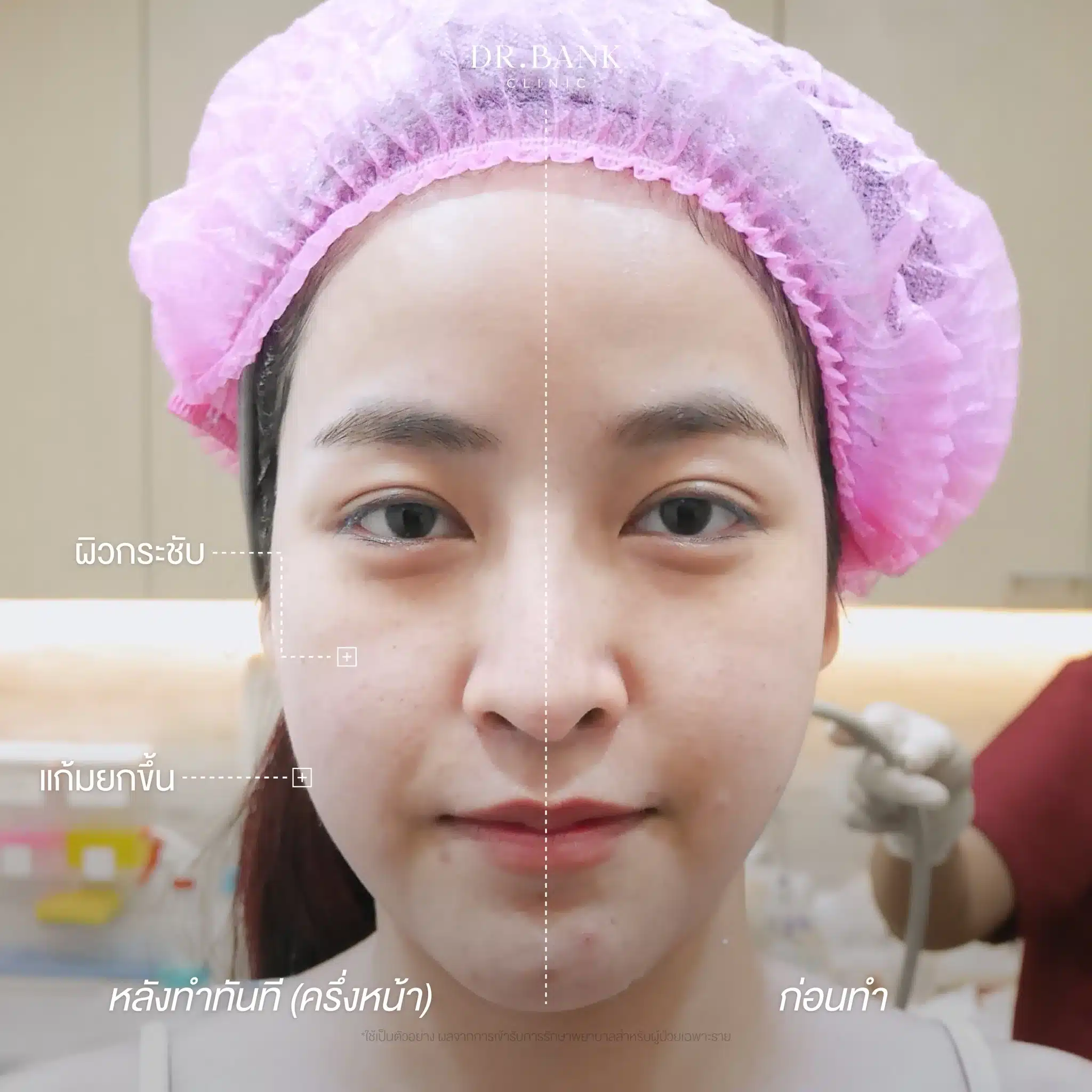 รีวิวโปรแกรมยกกระชับ Ultraformer III