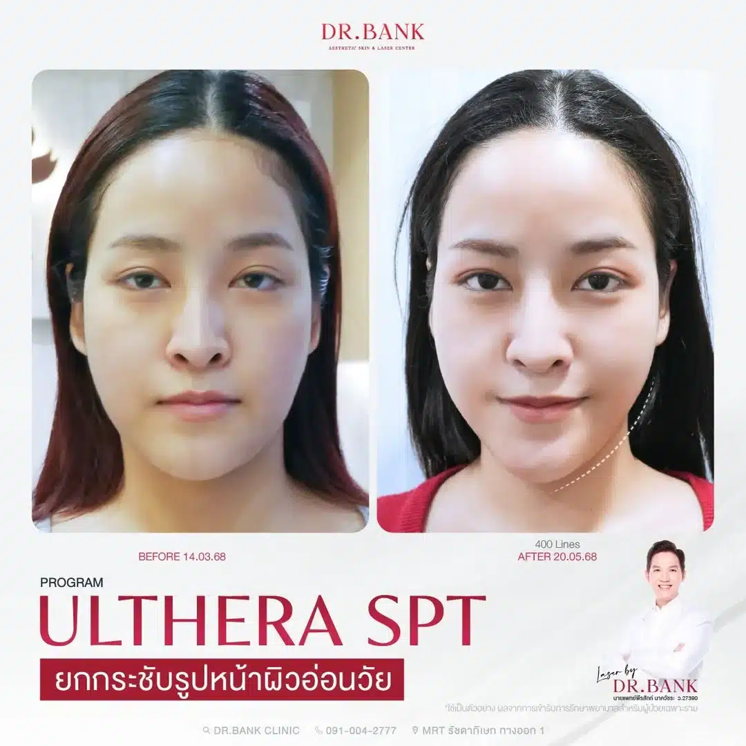 รีวิวโปรแกรมยกกระชับ Ulthera SPT