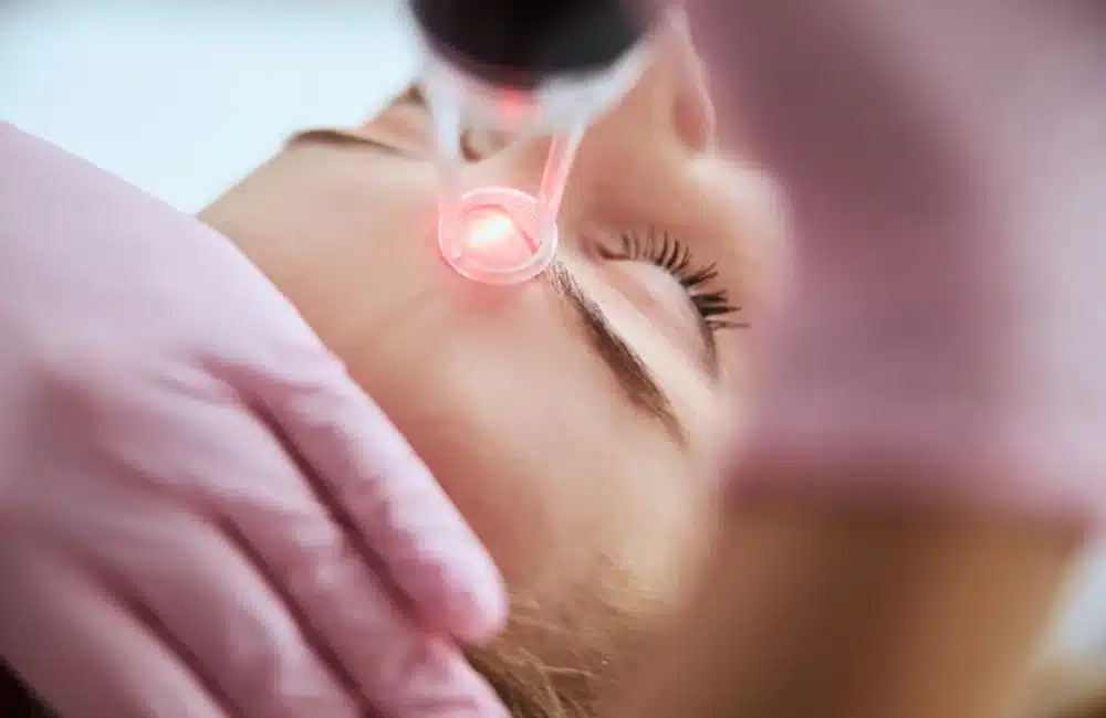 เลเซอร์รอยสิว