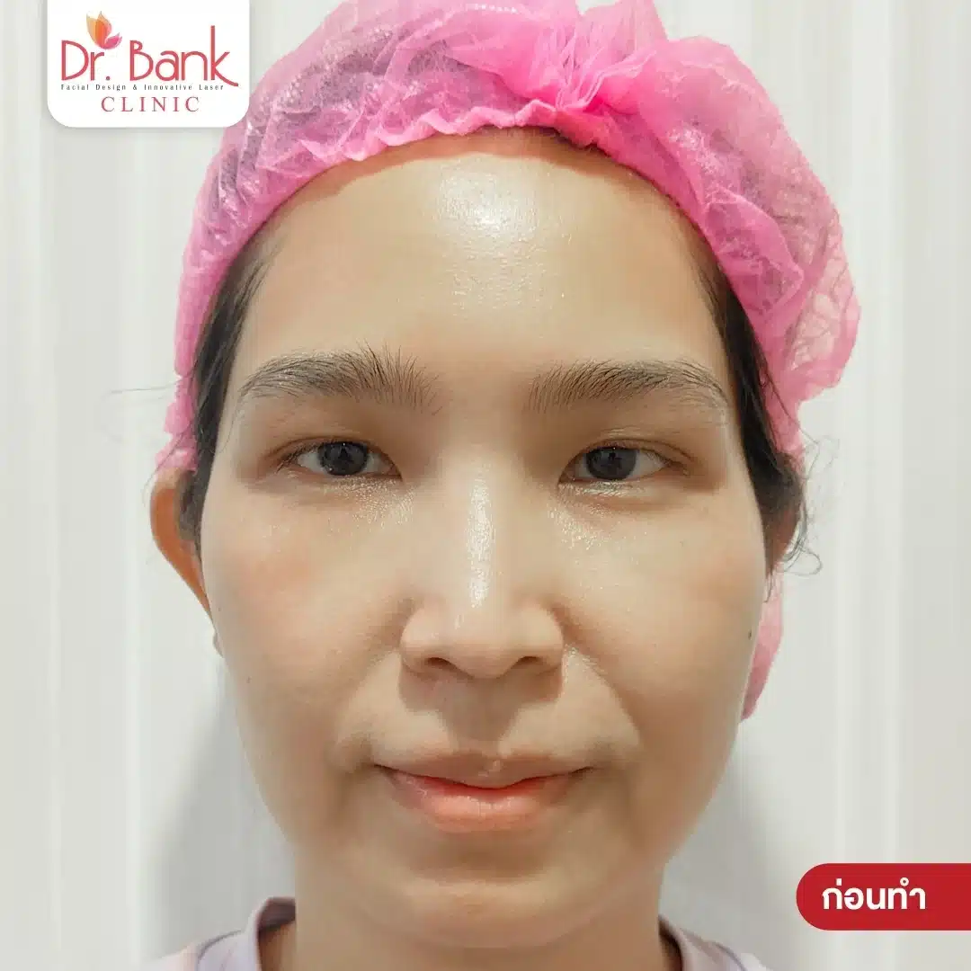 ก่อนทำ Ulthera