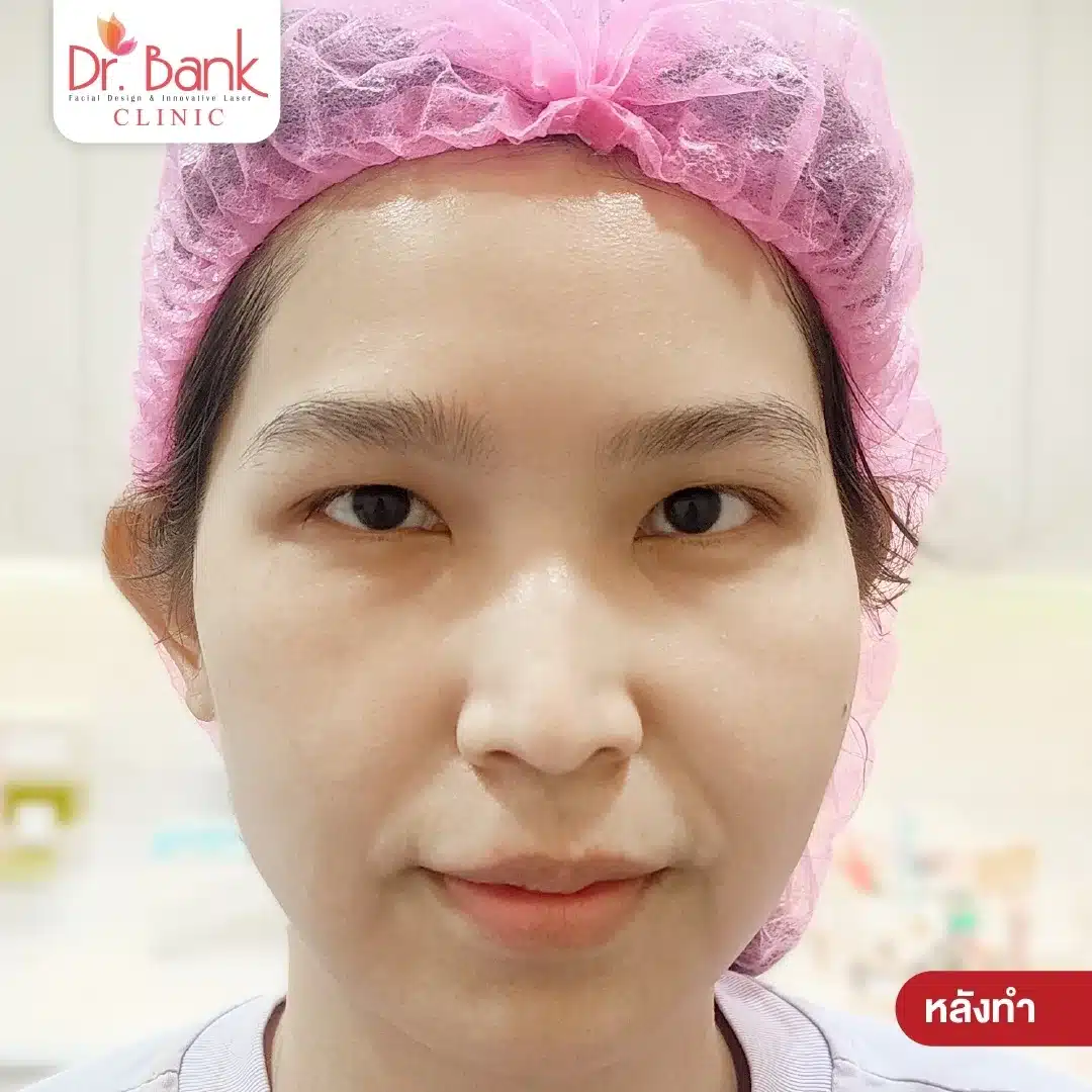 หลังทำ Ulthera